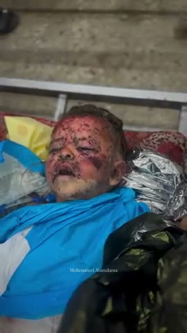 Burn victims never have any swelling, looks like iodine
