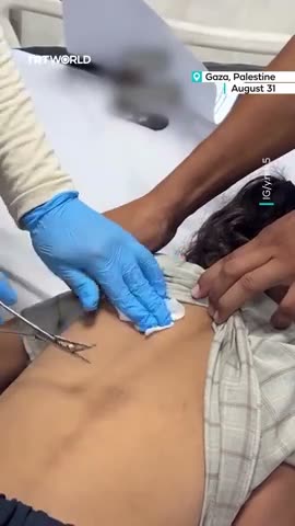 Doctors remove bullet from girl's back