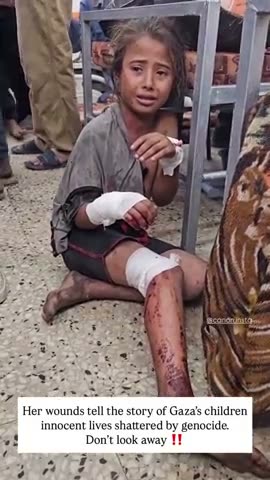 Girl of Gaza pretending to be burned